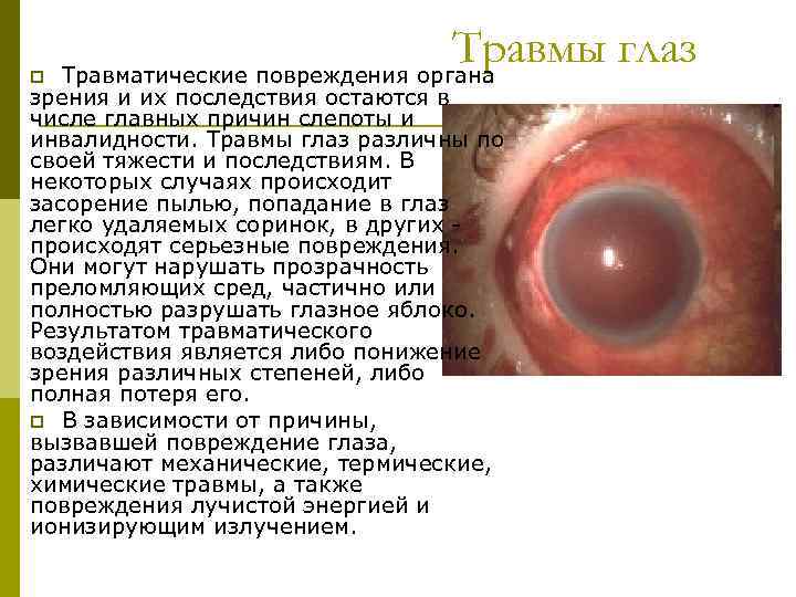 p Травмы глаз Травматические повреждения органа зрения и их последствия остаются в числе главных