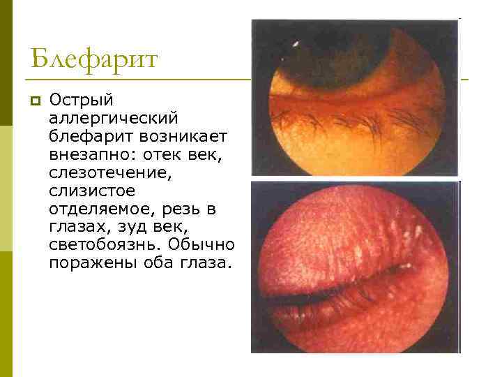 Блефарит p Острый аллергический блефарит возникает внезапно: отек век, слезотечение, слизистое отделяемое, резь в