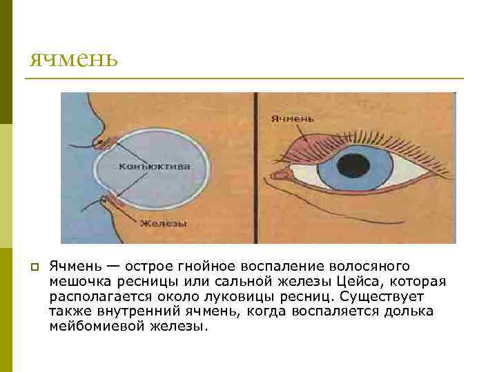 ячмень p Ячмень — острое гнойное воспаление волосяного мешочка ресницы или сальной железы Цейса,