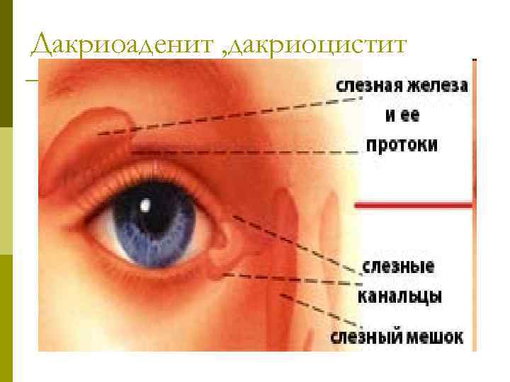 Дакриоаденит , дакриоцистит 