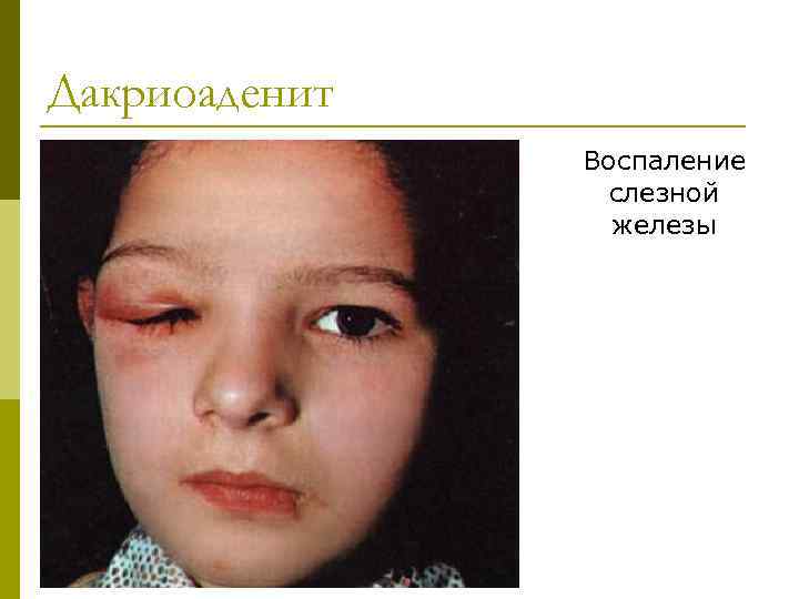 Дакриоаденит Воспаление слезной железы 