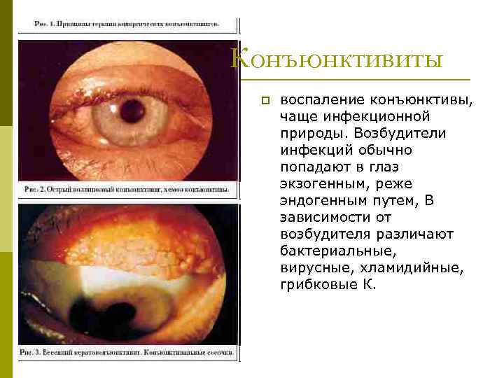 Конъюнктивиты p воспаление конъюнктивы, чаще инфекционной природы. Возбудители инфекций обычно попадают в глаз экзогенным,