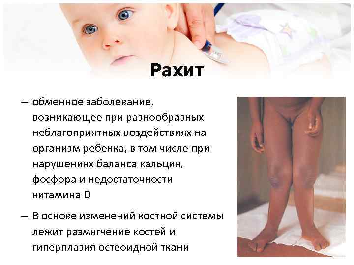 Рахит – обменное заболевание, возникающее при разнообразных неблагоприятных воздействиях на организм ребенка, в том