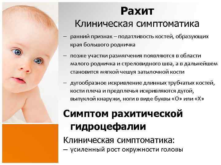 Рахит Клиническая симптоматика – ранний признак – податливость костей, образующих края большого родничка –