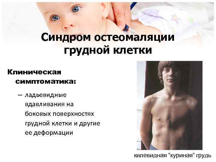 Синдром остеомаляции грудной клетки Клиническая симптоматика: – ладьевидные вдавливания на боковых поверхностях грудной клетки