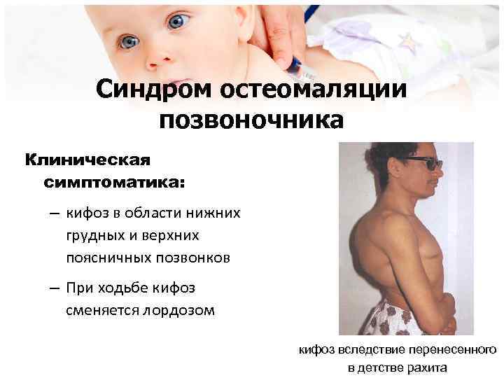 Синдром остеомаляции позвоночника Клиническая симптоматика: – кифоз в области нижних грудных и верхних поясничных