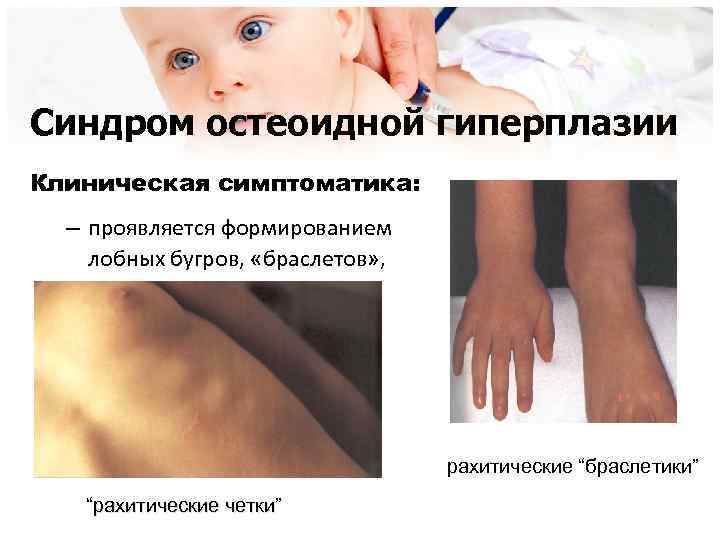 Синдром остеоидной гиперплазии Клиническая симптоматика: – проявляется формированием лобных бугров, «браслетов» , «четок» рахитические