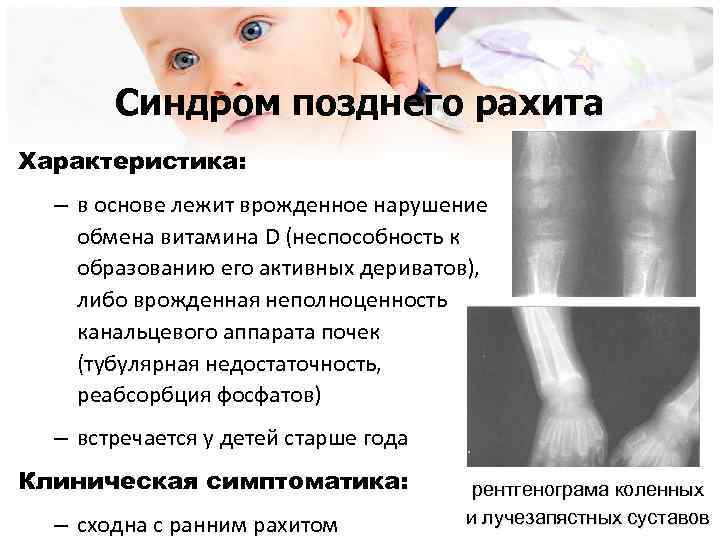 Синдром позднего рахита Характеристика: – в основе лежит врожденное нарушение обмена витамина D (неспособность