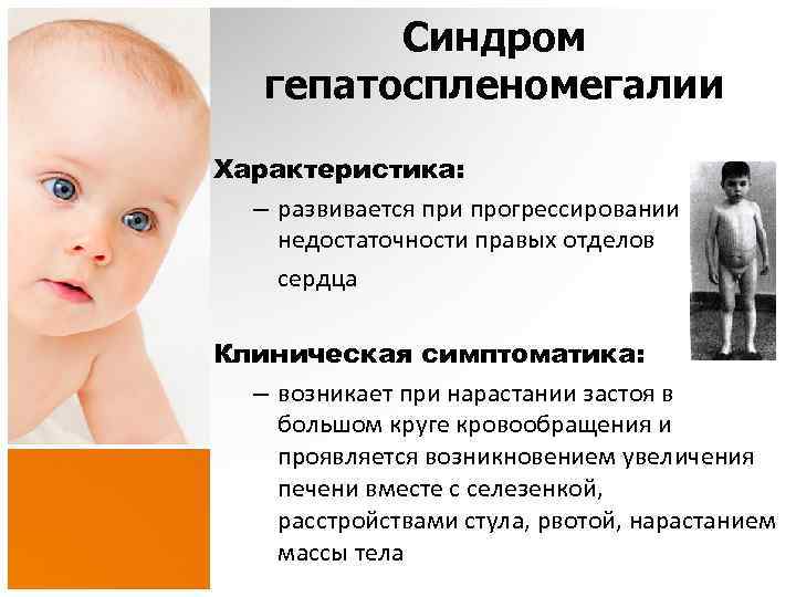 Синдром гепатоспленомегалии Характеристика: – развивается при прогрессировании недостаточности правых отделов сердца Клиническая симптоматика: –