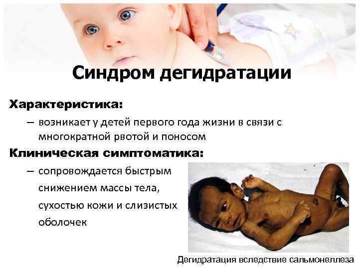 Синдром дегидратации Характеристика: – возникает у детей первого года жизни в связи с многократной