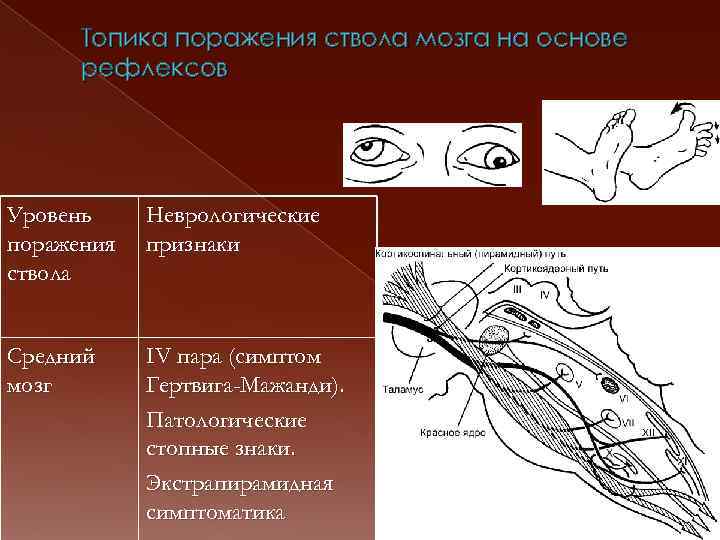 Топика поражения ствола мозга на основе рефлексов Уровень поражения ствола Неврологические признаки Средний мозг