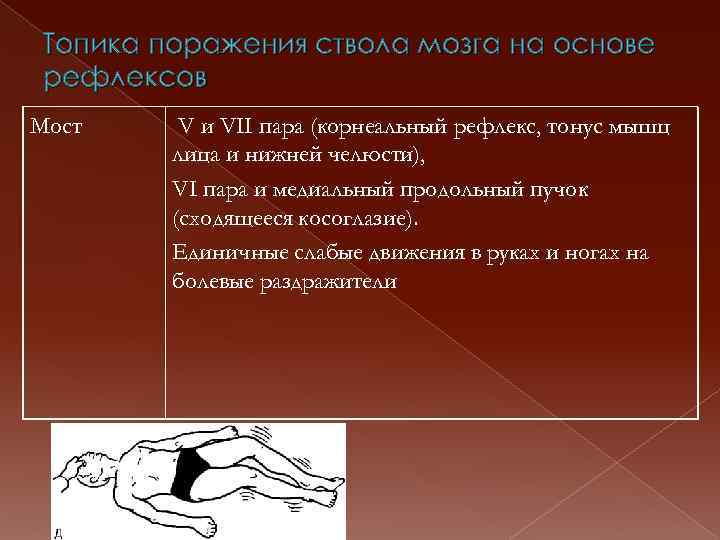 Топика поражения ствола мозга на основе рефлексов Мост V и VII пара (корнеальный рефлекс,