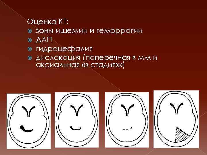 Оценка КТ: зоны ишемии и геморрагии ДАП гидроцефалия дислокация (поперечная в мм и аксиальная