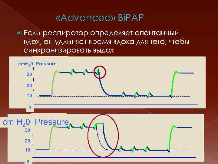  «Advanced» Bi. PAP Если респиратор определяет спонтанный вдох, он удлиняет время вдоха для