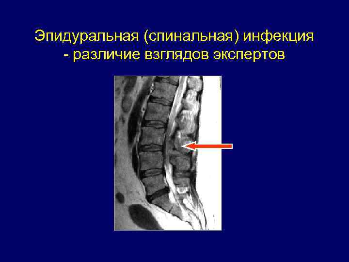 Эпидуральная (спинальная) инфекция - различие взглядов экспертов 