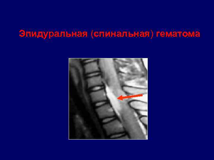 Эпидуральная (спинальная) гематома 