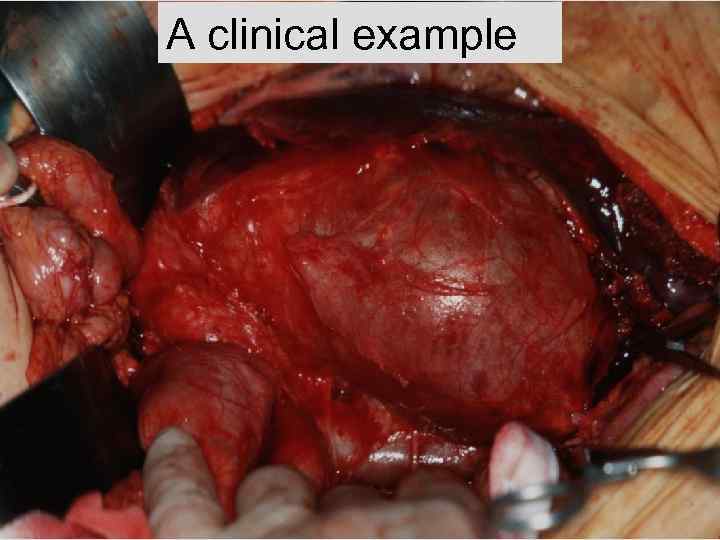 A clinical example AAA 02. ppt 