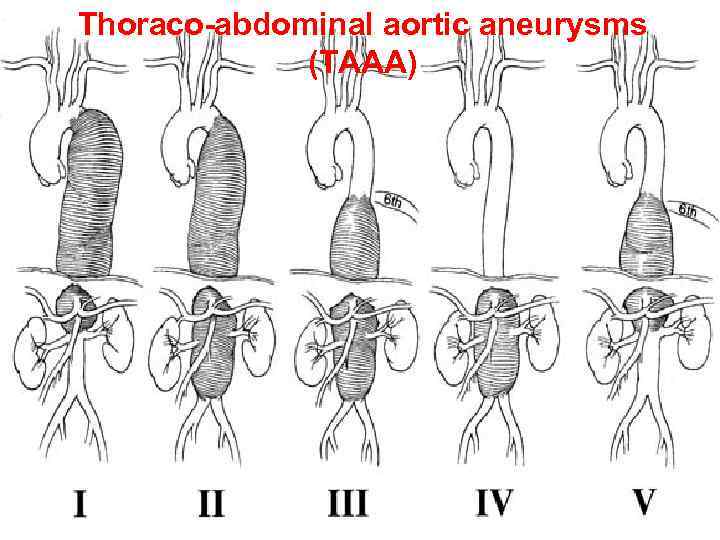 Thoraco-abdominal aortic aneurysms (TAAA) 