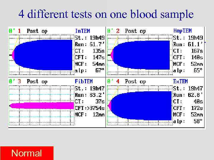 4 different tests on one blood sample Normal 