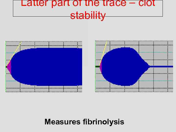 Latter part of the trace – clot stability Measures fibrinolysis 