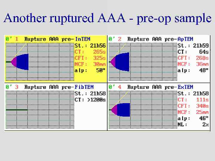 Another ruptured AAA - pre-op sample 