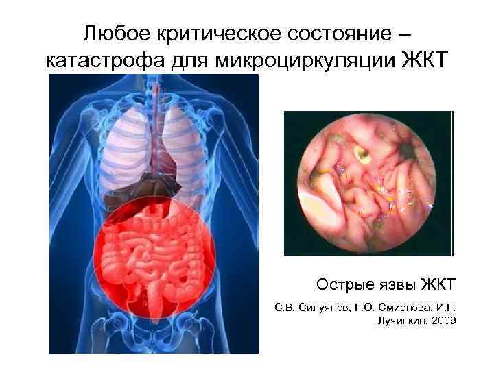 Любое критическое состояние – катастрофа для микроциркуляции ЖКТ Острые язвы ЖКТ С. В. Силуянов,