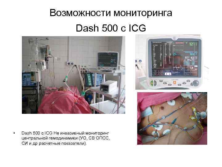 Возможности мониторинга Dash 500 с ICG • Dash 500 с ICG Не инвазивный мониторинг