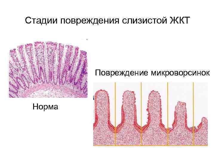 Стадии повреждения слизистой ЖКТ Повреждение микроворсинок Норма 