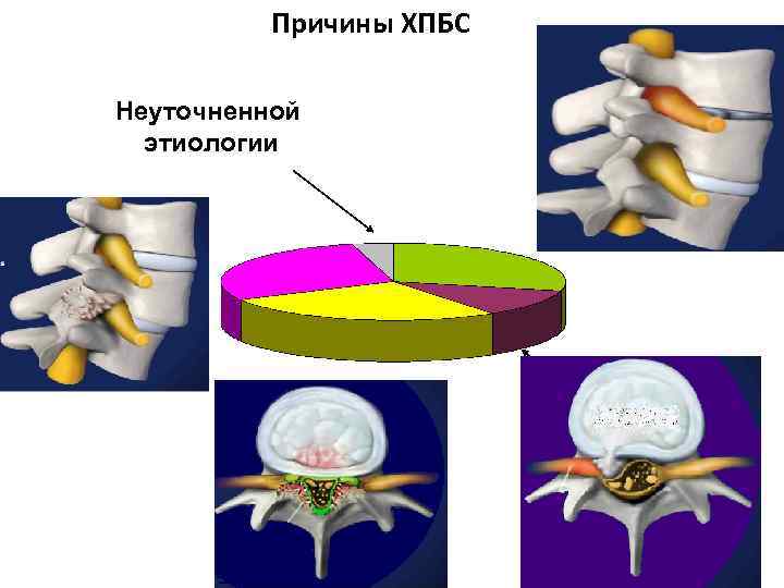 Причины ХПБС Неуточненной этиологии Рецидив грыжи фиброз Новая грыжа стеноз 