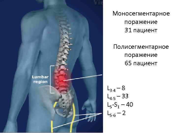Моносегментарное поражение 31 пациент Полисегментарное поражение 65 пациент L 3 -4 – 8 L