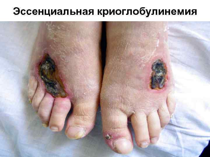Эссенциальная криоглобулинемия 