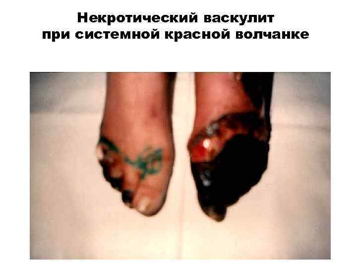 Некротический васкулит при системной красной волчанке 