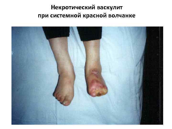 Некротический васкулит при системной красной волчанке 