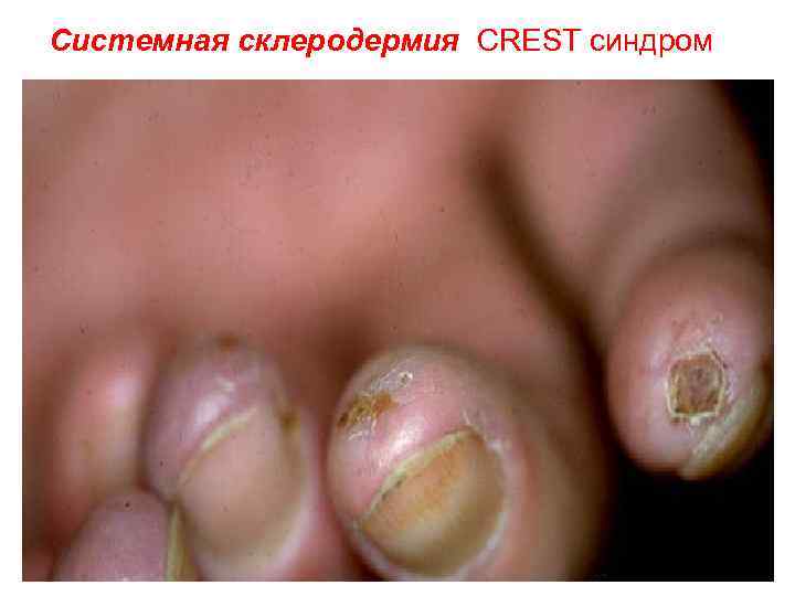 Системная склеродермия: CREST синдром 