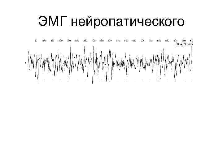 ЭМГ нейропатического 