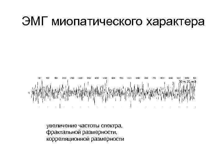 ЭМГ миопатического характера увеличение частоты спектра, фрактальной размерности, корреляционной размерности 