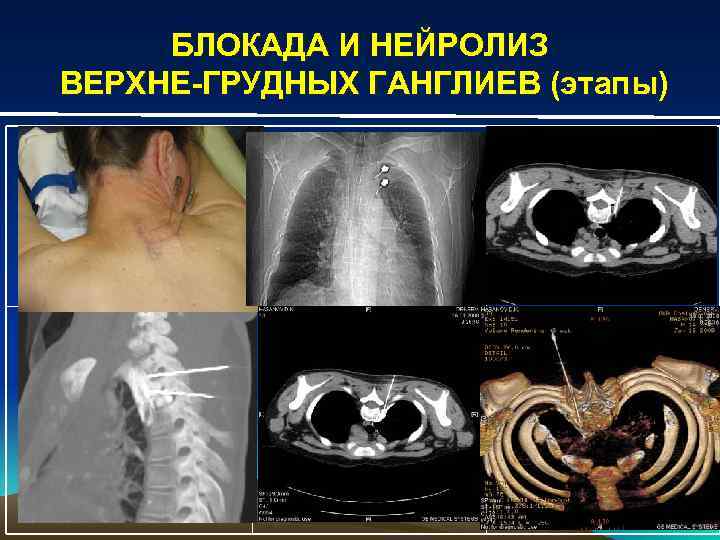 БЛОКАДА И НЕЙРОЛИЗ ВЕРХНЕ-ГРУДНЫХ ГАНГЛИЕВ (этапы) 