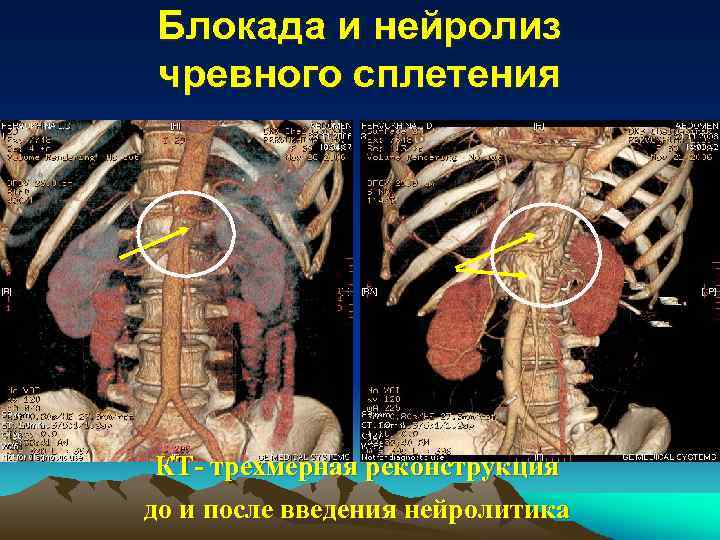 Блокада и нейролиз чревного сплетения КТ- трехмерная реконструкция до и после введения нейролитика 