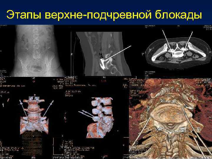 Этапы верхне-подчревной блокады 