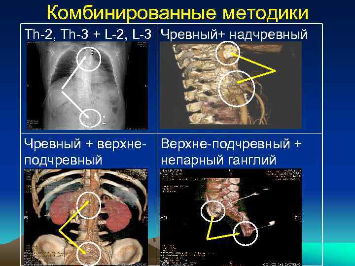 Комбинированные методики Th-2, Th-3 + L-2, L-3 Чревный+ надчревный Чревный + верхнеподчревный Верхне-подчревный +