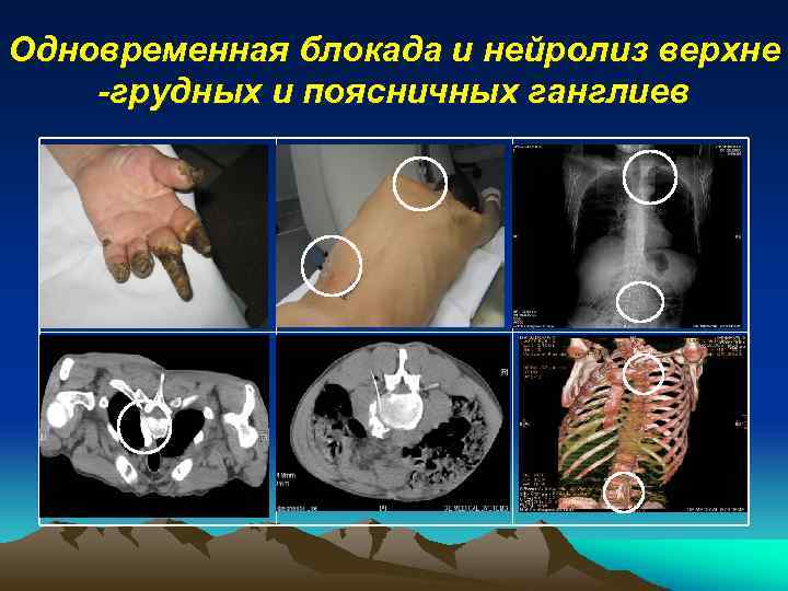 Одновременная блокада и нейролиз верхне -грудных и поясничных ганглиев 