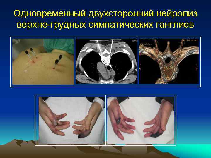 Одновременный двухсторонний нейролиз верхне-грудных симпатических ганглиев 
