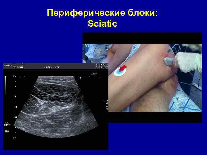 Периферические блоки: Sciatic 