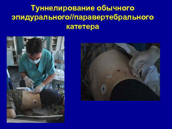 Туннелирование обычного эпидурального//паравертебрального катетера 