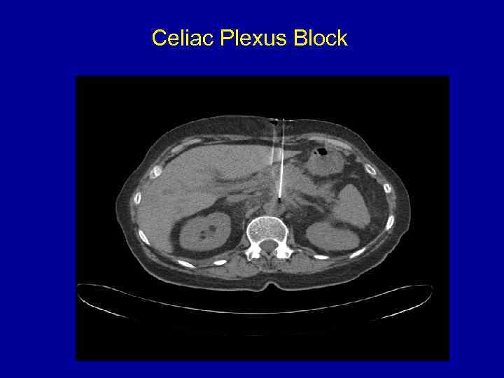 Celiac Plexus Block 