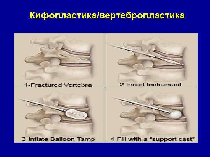 Кифопластика/вертебропластика 