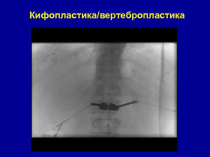 Кифопластика/вертебропластика 