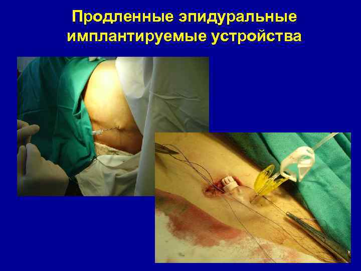 Продленные эпидуральные имплантируемые устройства 