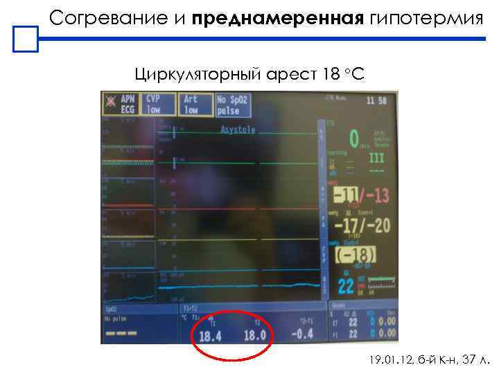 Согревание и преднамеренная гипотермия Циркуляторный арест 18 С 19. 01. 12, б-й К-н, 37