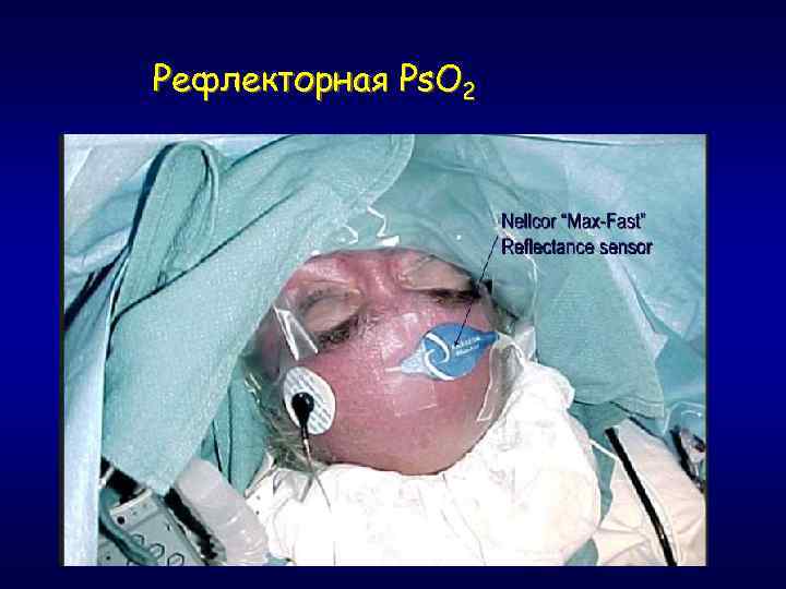 Рефлекторная Ps. O 2 